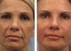 העור של הפנים והידיים, ללא פיגמנטציה וקמטים עבור 15 רובל: התוצאה של השימוש 1-יום