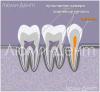 כיצד למצוא ולטפל בתעלות שיניים בלומידנט