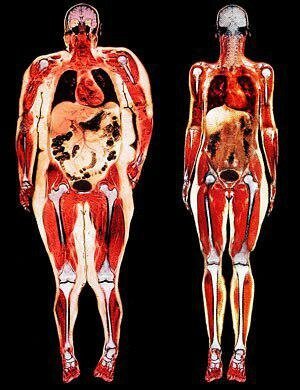 שמאל - רק להשמנה קרבית. כל איברים נחנקו עם שומן.