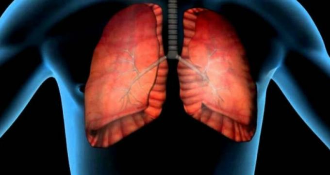 סרטן הריאות