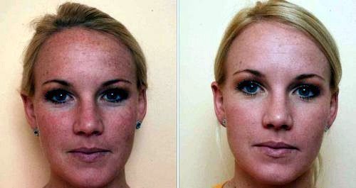 פחמן פילינג. תמונות לפני ואחרי. לחולה יש סוג עור שמנוני.