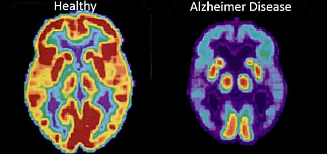 הדימוי הראשון - המוח של אדם בריא, והשני - מחלת האלצהיימר 