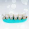 שיני קיבוע פופולריות: כמה זה יעיל?