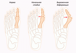 כיצד להסיר עצם בכף הרגל