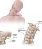4 תרגילים בסיסיים לעמוד השדרה הצווארי יעזרו לכם לשכוח מכאבים ואוסטאוכונדרוזיס!