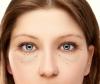 איך להיפטר ללא ניתוח, בקע ושקיות עין עפעפיים תחתונות